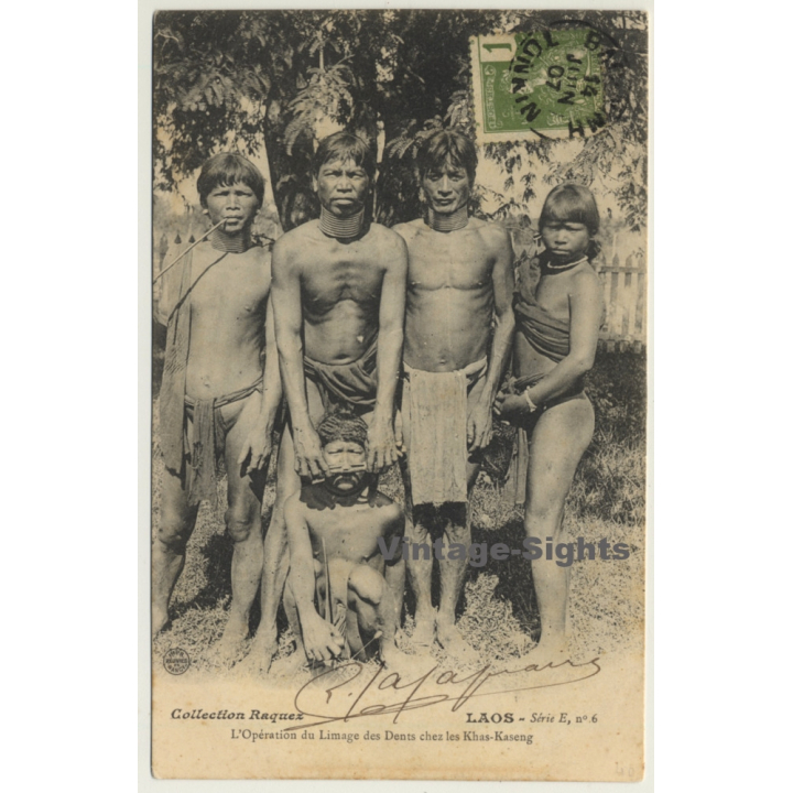 Laos: L'Operation Du Limage De Dents / Khas-Kaseng (Vintage PC 1907 Ethno)