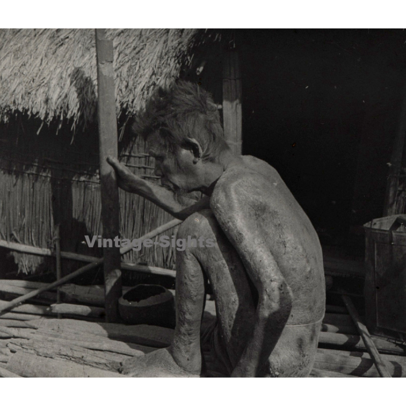 Vietnam: Sauvage Moï / Leper - Leprosy (Vintage Stereo Glass Plate ~1920s/1930s)
