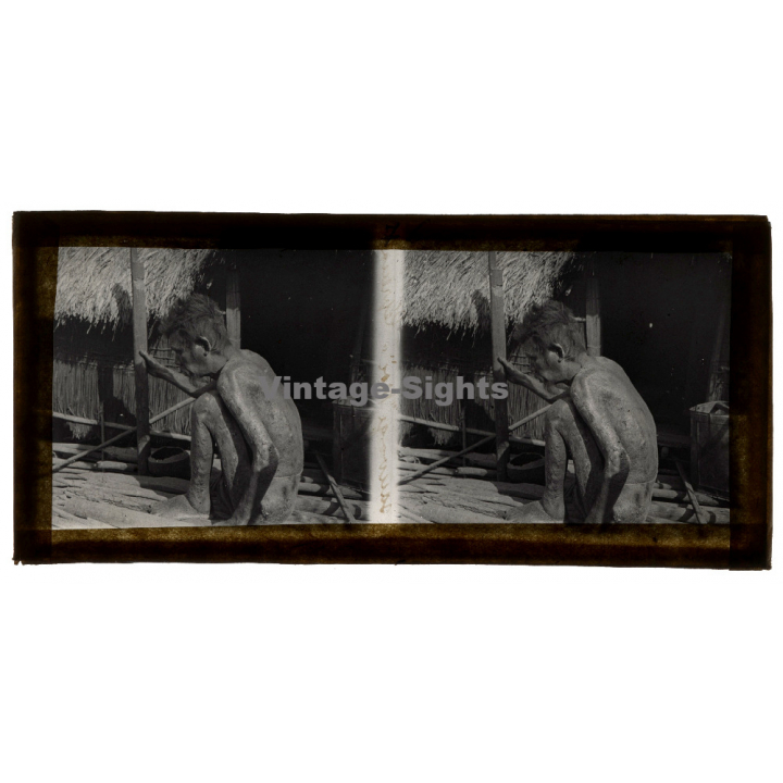 Vietnam: Sauvage Moï / Leper - Leprosy (Vintage Stereo Glass Plate ~1920s/1930s)