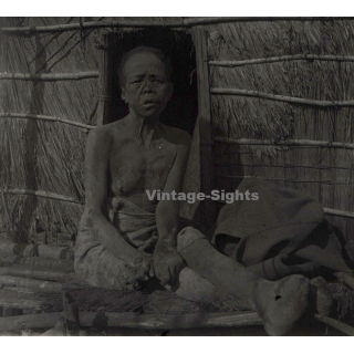 Vietnam: Woman Severely Suffering From Leprosy / Leper (Vintage Stereo Glass Plate ~1920s/1930s)