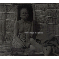 Vietnam: Woman Severely Suffering From Leprosy / Leper (Vintage Stereo Glass Plate ~1920s/1930s)