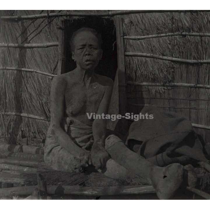 Vietnam: Woman Severely Suffering From Leprosy / Leper (Vintage Stereo Glass Plate ~1920s/1930s)