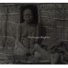 Vietnam: Woman Severely Suffering From Leprosy / Leper (Vintage Stereo Glass Plate ~1920s/1930s)