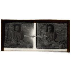 Vietnam: Woman Severely Suffering From Leprosy / Leper (Vintage Stereo Glass Plate ~1920s/1930s)