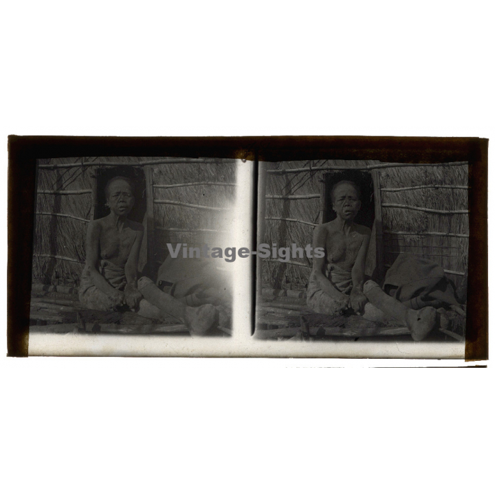 Vietnam: Woman Severely Suffering From Leprosy / Leper (Vintage Stereo Glass Plate ~1920s/1930s)