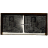 Vietnam: Woman Severely Suffering From Leprosy / Leper (Vintage Stereo Glass Plate ~1920s/1930s)