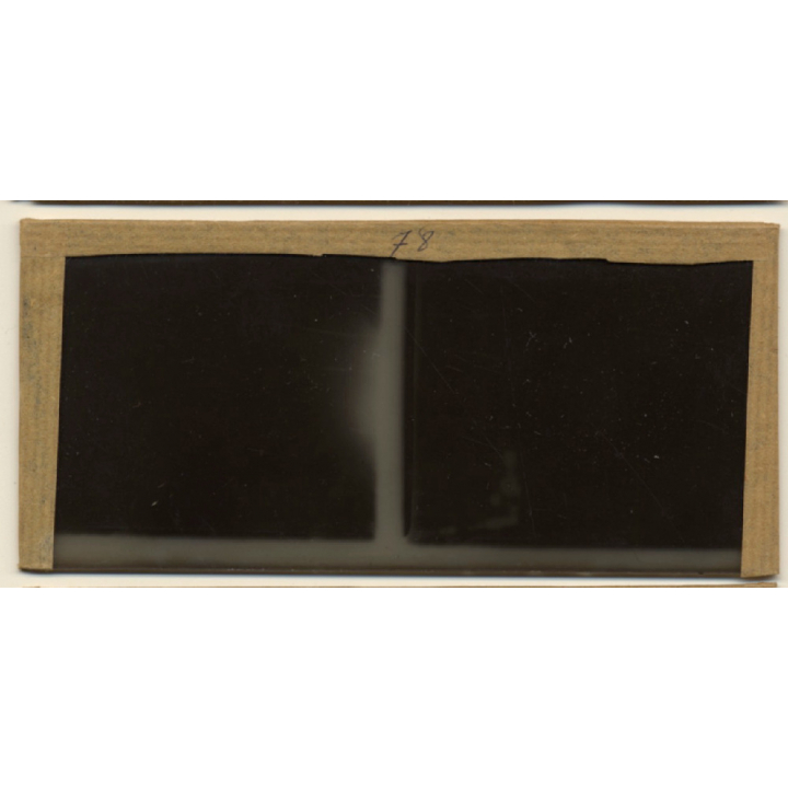 Vietnam: Woman Severely Suffering From Leprosy / Leper (Vintage Stereo Glass Plate ~1920s/1930s)