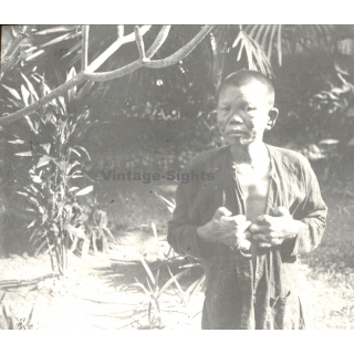 Vietnam: Nativ Moï Suffering From Leprosy / Leper (Vintage Stereo Glass Plate ~1920s/1930s)