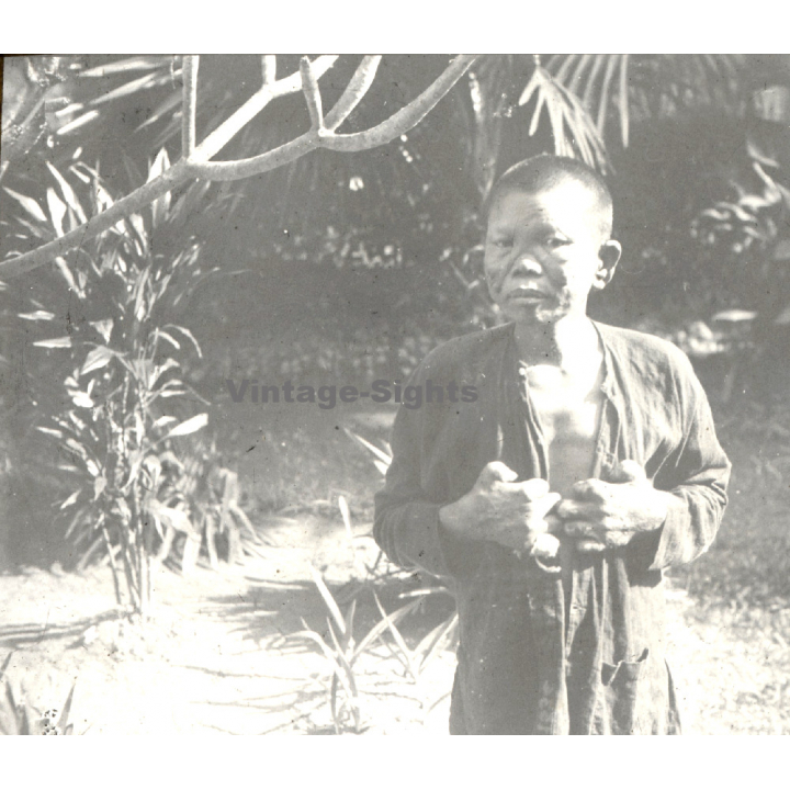 Vietnam: Nativ Moï Suffering From Leprosy / Leper (Vintage Stereo Glass Plate ~1920s/1930s)