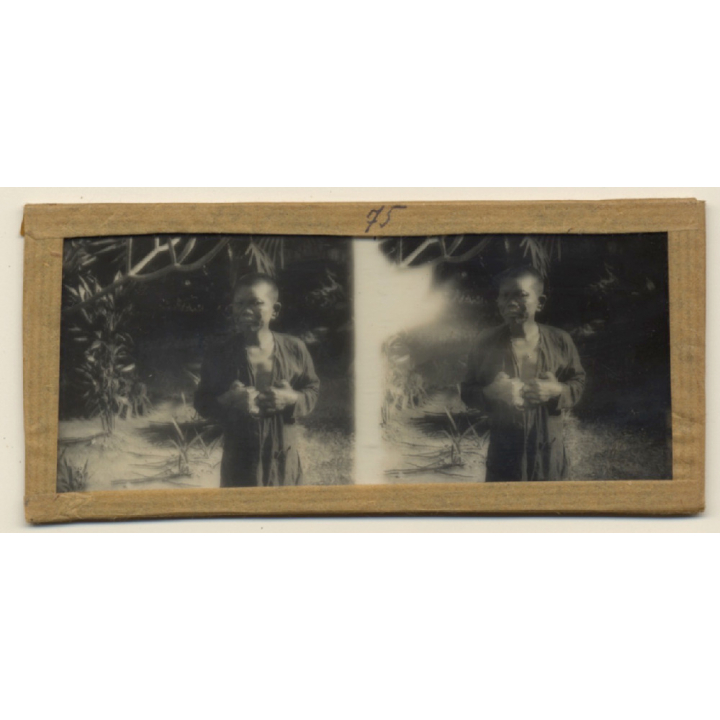 Vietnam: Nativ Moï Suffering From Leprosy / Leper (Vintage Stereo Glass Plate ~1920s/1930s)