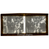Vietnam: Missionary & Nativ Moï Suffering From Leprosy (Vintage Stereo Glass Plate ~1920s/1930s)