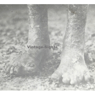 Vietnam: Close-up Of Of Feet Of Leper / Leprosy Colony (Vintage Stereo Glass Plate ~1920s/1930s)