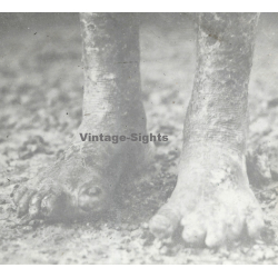 Vietnam: Close-up Of Of Feet Of Leper / Leprosy Colony (Vintage Stereo Glass Plate ~1920s/1930s)