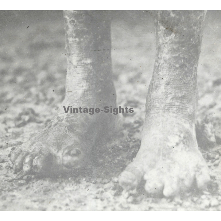 Vietnam: Close-up Of Of Feet Of Leper / Leprosy Colony (Vintage Stereo Glass Plate ~1920s/1930s)