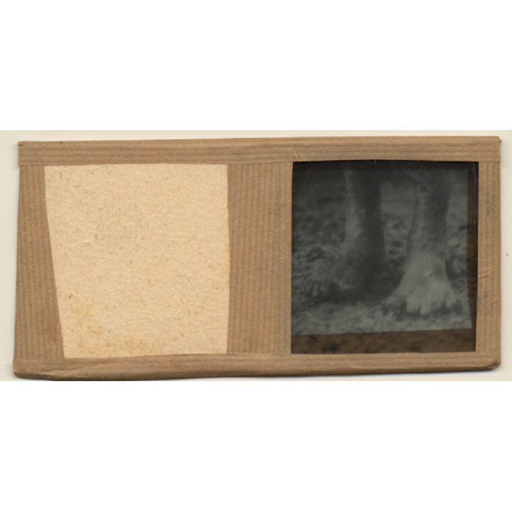 Vietnam: Close-up Of Of Feet Of Leper / Leprosy Colony (Vintage Stereo Glass Plate ~1920s/1930s)