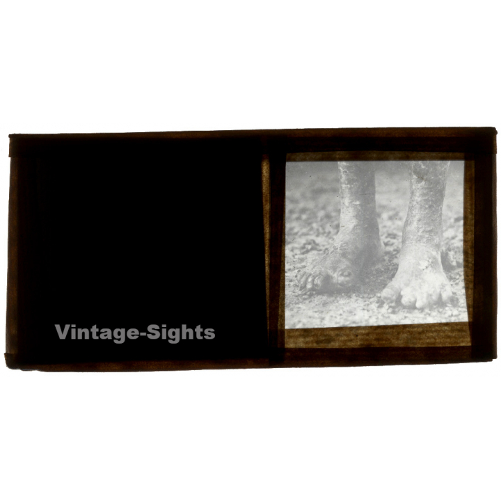 Vietnam: Close-up Of Of Feet Of Leper / Leprosy Colony (Vintage Stereo Glass Plate ~1920s/1930s)