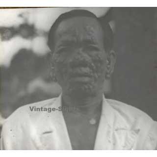 Vietnam: Moï Severely Suffering From Leprosy / Leper Colony (Vintage Stereo Glass Plate ~1920s/1930s)