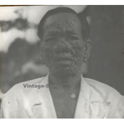 Vietnam: Moï Severely Suffering From Leprosy / Leper Colony (Vintage Stereo Glass Plate ~1920s/1930s)