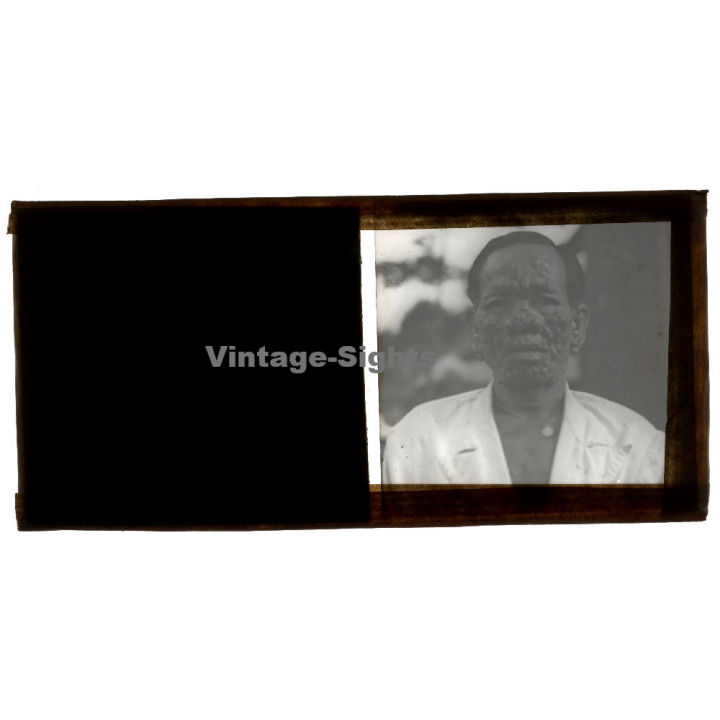 Vietnam: Moï Severely Suffering From Leprosy / Leper Colony (Vintage Stereo Glass Plate ~1920s/1930s)