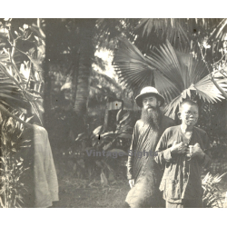 Vietnam: Missionary & Nativ Moï Suffering From Leprosy (Vintage Stereo Glass Plate ~1920s/1930s)